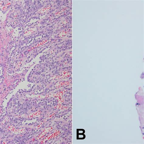 Photomicrograph Of The Stomach A Sarcina Ventriculi Identification In