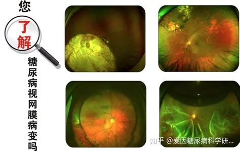 糖尿病眼病不可小觑 警惕糖尿病眼病致盲危险 知乎