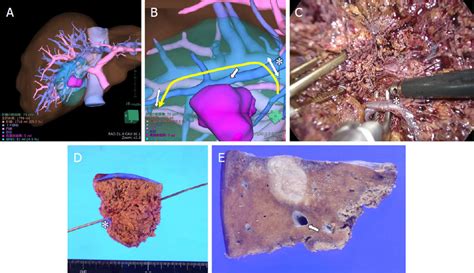 Laparoscopic Partial Liver Resection Of Segment 5 A Preoperative