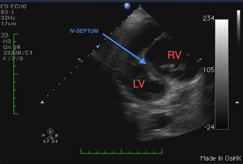 Right Heart Strain Ultrasound Cases Info