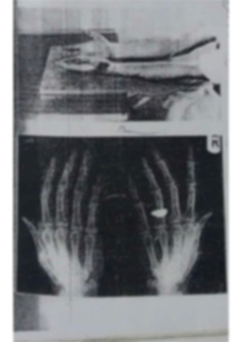 Solution Posterior Oblique Both Hand Xray Radiography Studypool