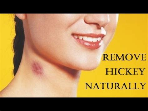 How To Get Rid Of Hickies Fast Remove A Hickey At Home Youtube