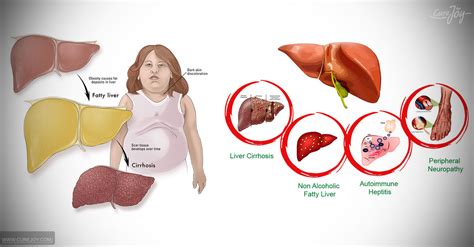 Non-Alcoholic Fatty Liver Disease (NAFLD): Causes And Symptoms