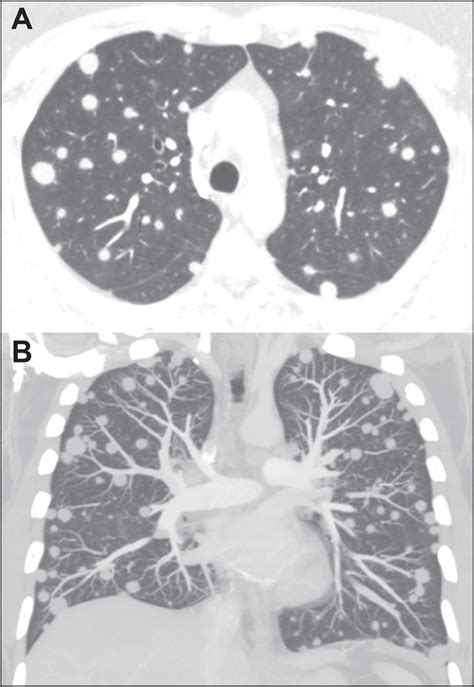 Scielo Brasil Computed Tomography Findings Of Pulmonary