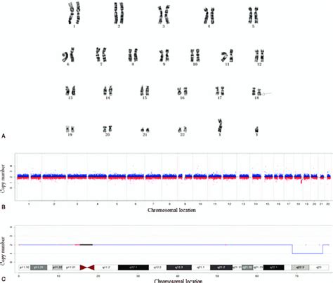 Genetic Test Results Prenatal Diagnosis Of Monosomy 18q Deletion Download Scientific Diagram