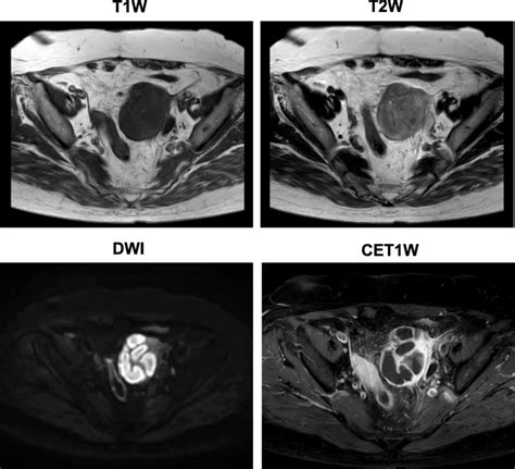 Magnetic Resonance Imaging Axial T1 Weighted Images Through The Pelvis