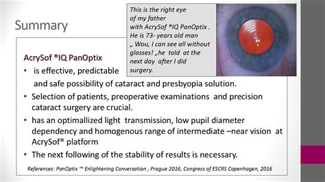 Escrs Correction Of Presbyopia At Cataract Surgery With Trifocal Intraocular Lens With