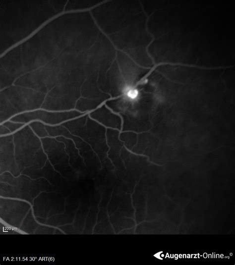 Rupturiertes Mikroaneurysma Atlas Der Augenheilkunde