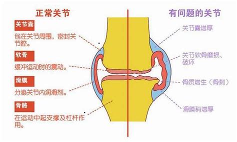 什么是膝关节骨性关节炎？怎么判断是不是得了膝盖的骨关节炎？凤凰网