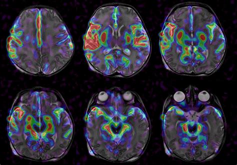 A D Pseudo Continuous Arterial Spin Labeling Sequence With A