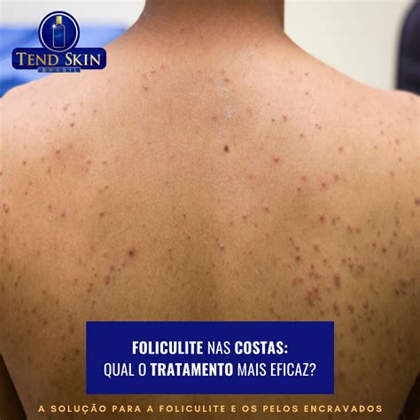 Foliculite Nas Costas Qual O Tratamento Mais Eficaz Dr Foliculite