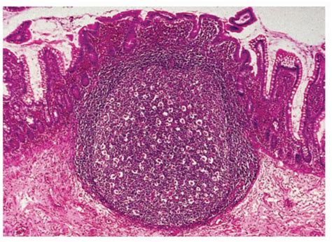 Small Bowel Mucosal Disease Basicmedical Key