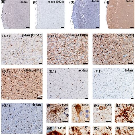 Doublelabeled Immunostaining Against Phosphotau Ptaucp And