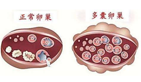 什么是多囊卵巢综合征多囊有什么危害怎么检查治疗