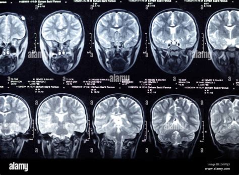 Cairo, Egypt, September 26 2024: MRI brain reveals functioning intra-ventricular shunt drain ...