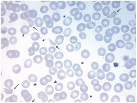 Peripheral Blood Smear Leishman Stain Shows Fragmented Red Blood