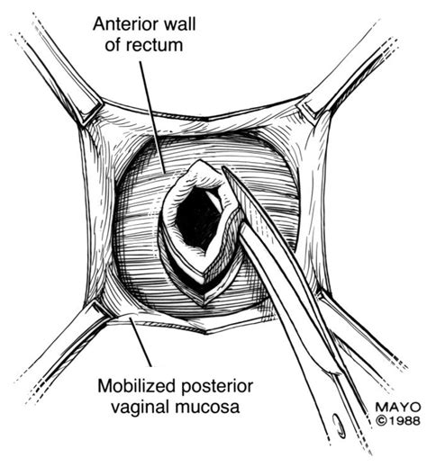 Rectal Advancement Flap Rectovaginal Fistula