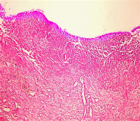 10. Fibrinoidna necrosis (bottom of a stomach ulcer). | Pathology