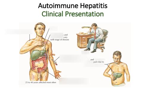 Autoimmune Hepatitis Clinical Presentation Diagram Quizlet