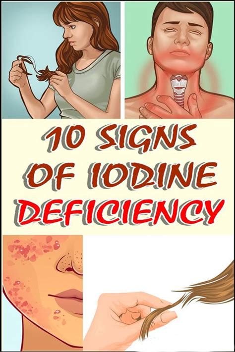 Signs Of Iodine Deficiency Iodine Deficiency Iodine Iodine