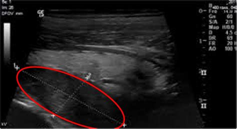 Ultrasound scan of the neck depicting parathyroid adenoma. | Download Scientific Diagram