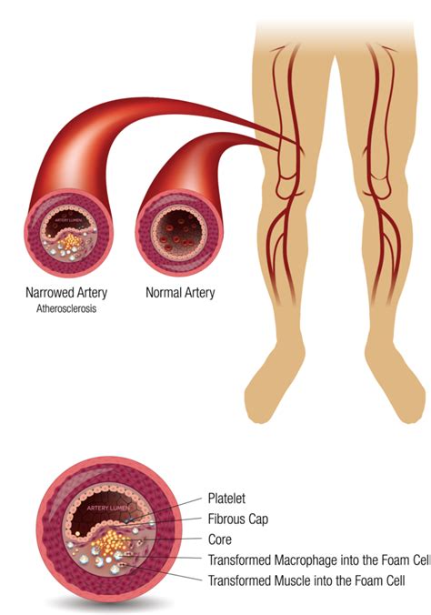 Efemoral Medical | Peripheral Vascular Disease