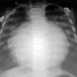 Chest X-ray showing significant cardiomegaly. | Download Scientific Diagram