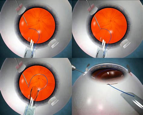 Figure From Handshake Technique For Glued Intrascleral Haptic