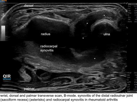 Swiss Ultrasound Center Uzr On Twitter Synoviti In The Distal Radioulnar Joint Sacciform