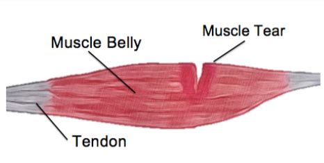 The Four Mistakes You Can Make After A Muscle Tear