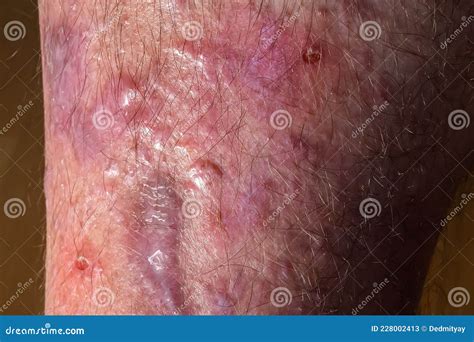 Lichen Planus On Leg Skin Close Up Dermatological Disease In Form Of