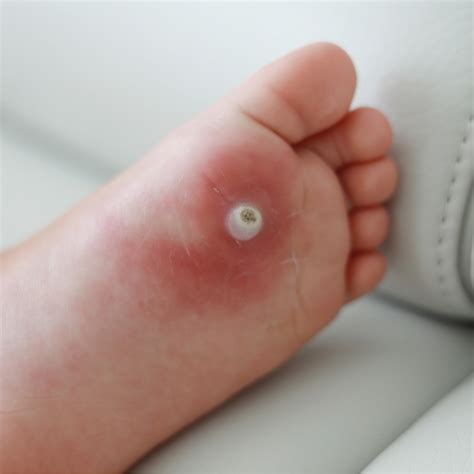 Preventing Pesky Plantar Warts This Summer Tucson Podiatrist