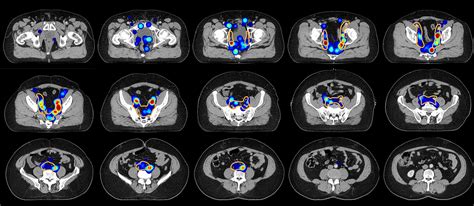 Frontiers The Distribution Of Pelvic Nodal Metastases In Prostate