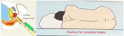 Transrectal Ultrasound Prostate Biopsy