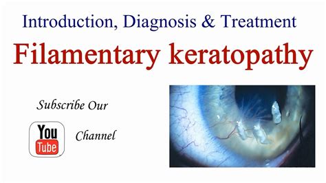 Filamentary Keratopathy / Keratitis Introduction, Causes, Diagnosis and ...