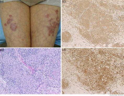 Cutaneous Sarcoid with Livedoid Changes in a Patient with Hashimoto's