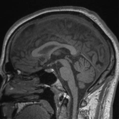 Pineal Gland Mri