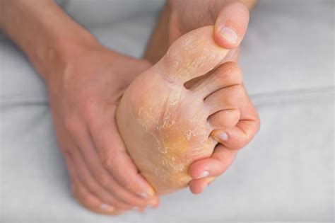 Premium Photo Man With Peeling And Cracked Feet Fungal Infection Or