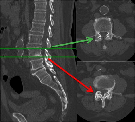 Degenerative Disc Disease Ddd Lubbock Amarillo Midland Sergiy