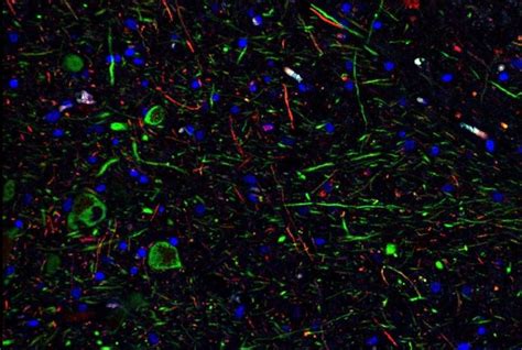 SARS CoV 2 Can Infect Dopamine Neurons Causin EurekAlert