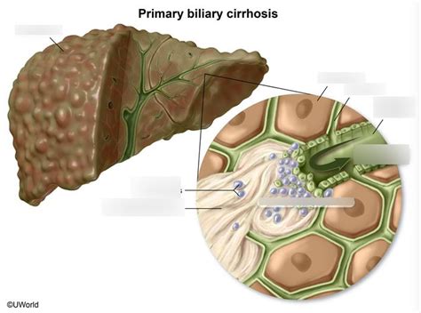 Diagram Of Primary Biliary Cirrhosis Quizlet