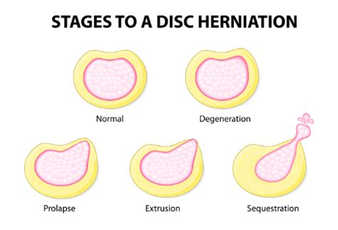 Bulging Disc vs. Herniated Disc: What's the Difference? Can ...