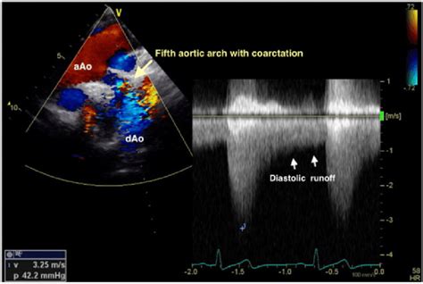 Suprasternal View In Transthoracic Echocardiography Showing Flow