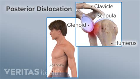 Diagnosing A Dislocated Shoulder Shoulder Dislocation Shoulder Injuries Medical History