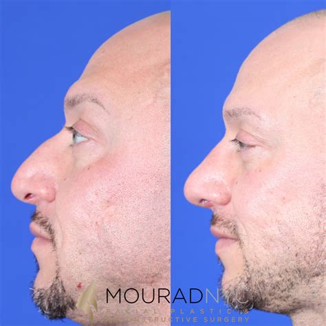 Male Deviated Septum Rhinoplasty Before And After Facial Plastic