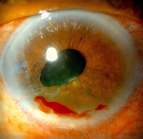 Intracorneal Hemorrhage In Marginal Keratitis American Academy Of Ophthalmology