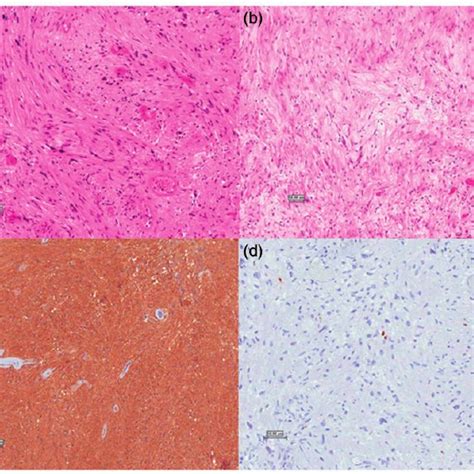 A The Tumor Is Composed Of Spindle Cells Arranged In Ill Defined