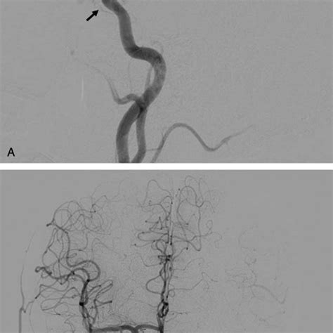 A Pre Embolization Angiogram Angiogram Of The Internal Carotid