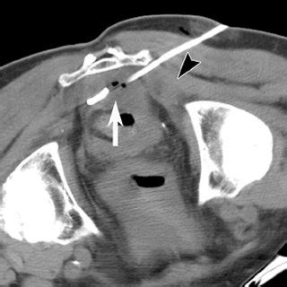 PDF Transgluteal Approach For Percutaneous Drainage Of Deep Pelvic