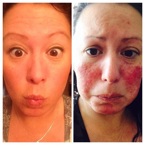 Before And After Pic Just Only 4 Weeks Of Progress Into Getting My Rosacea Under Control